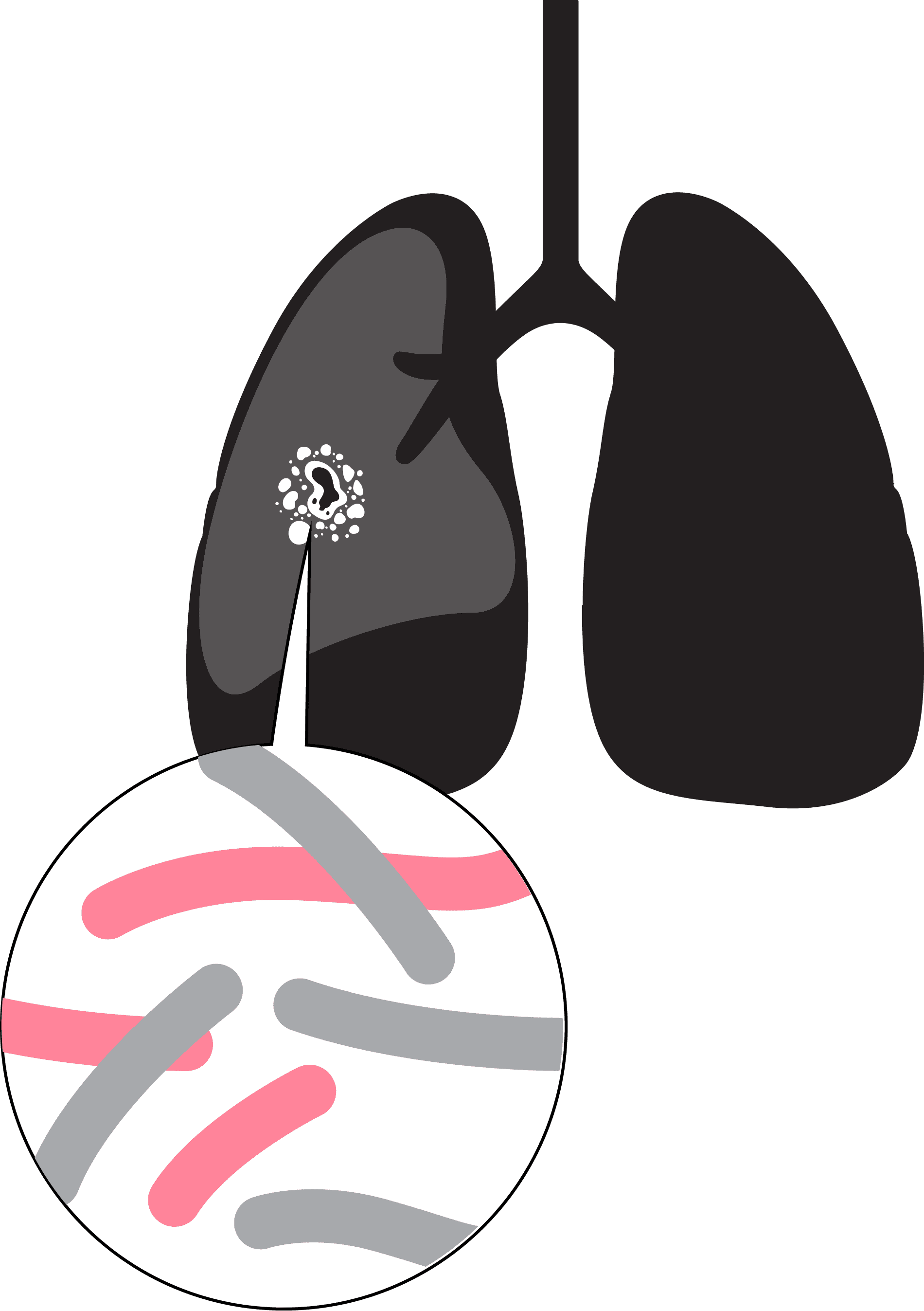 TB in granuloma